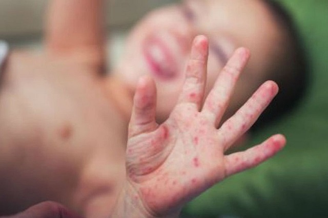 Quy định 10 bệnh truyền nhiễm phải cách ly bắt đầu có hiệu lực